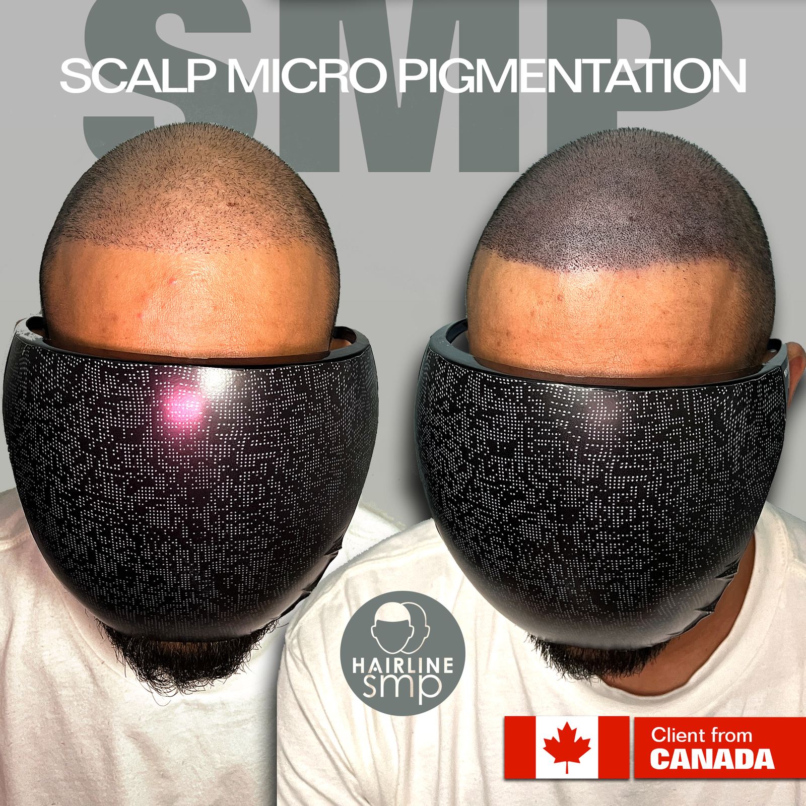 0 — scalp micropigmentation at Hairline SMP Zirakpur