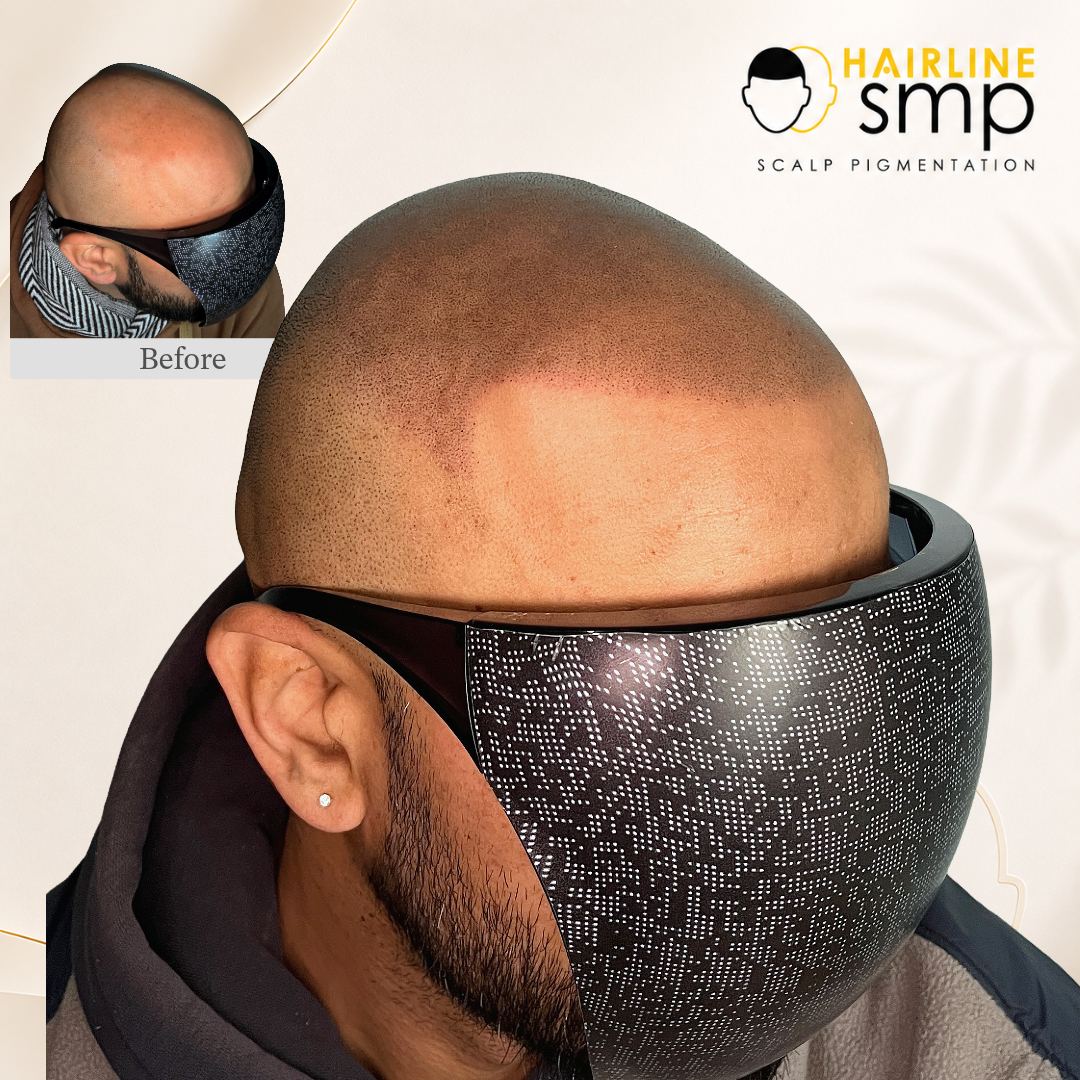 2 — scalp micropigmentation at Hairline SMP Zirakpur