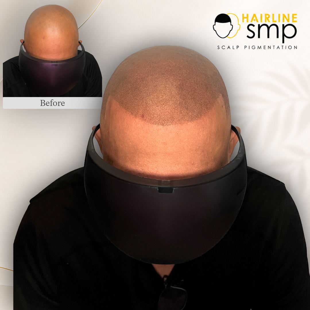 hairline result — scalp micropigmentation at Hairline SMP Zirakpur