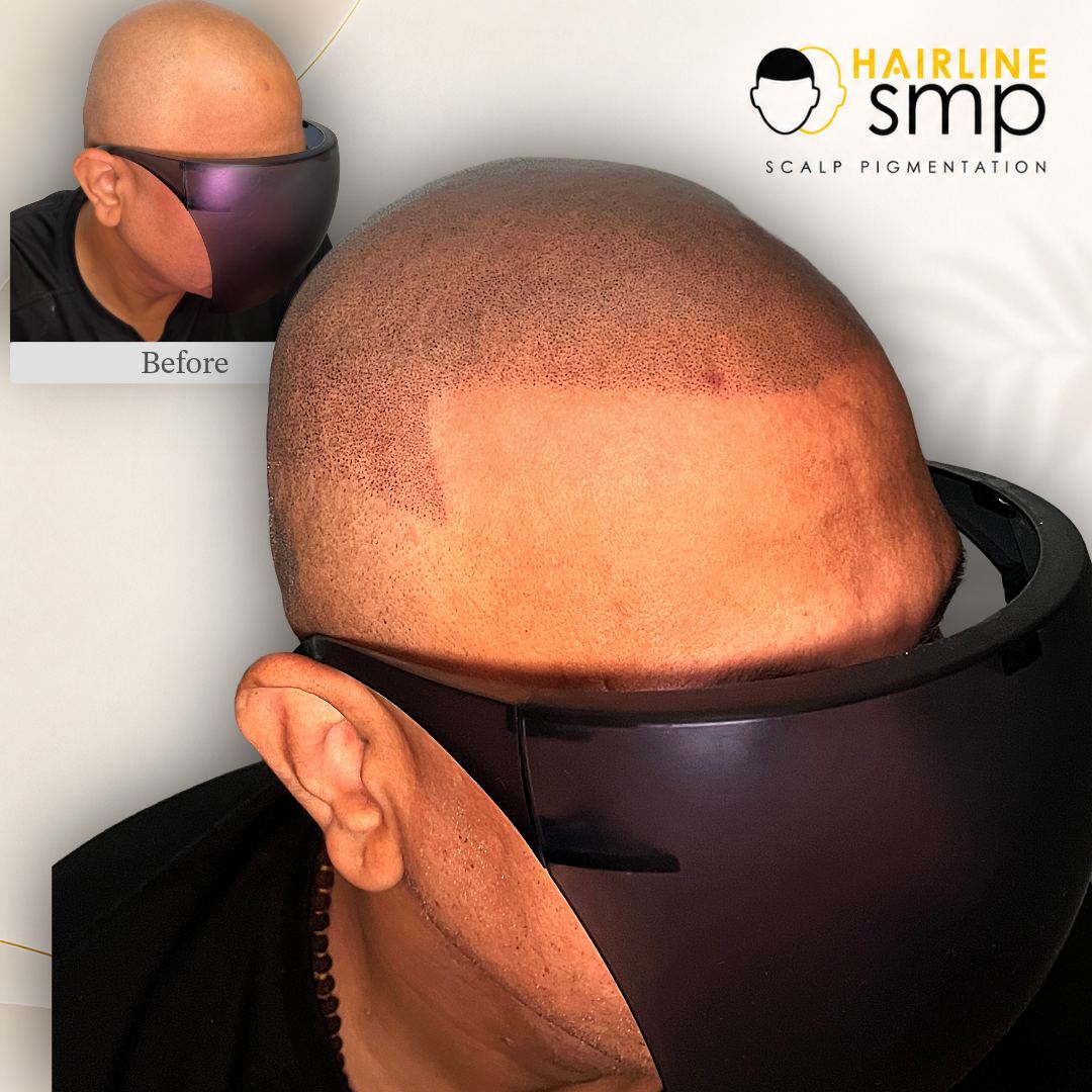 hero smp — scalp micropigmentation at Hairline SMP Zirakpur