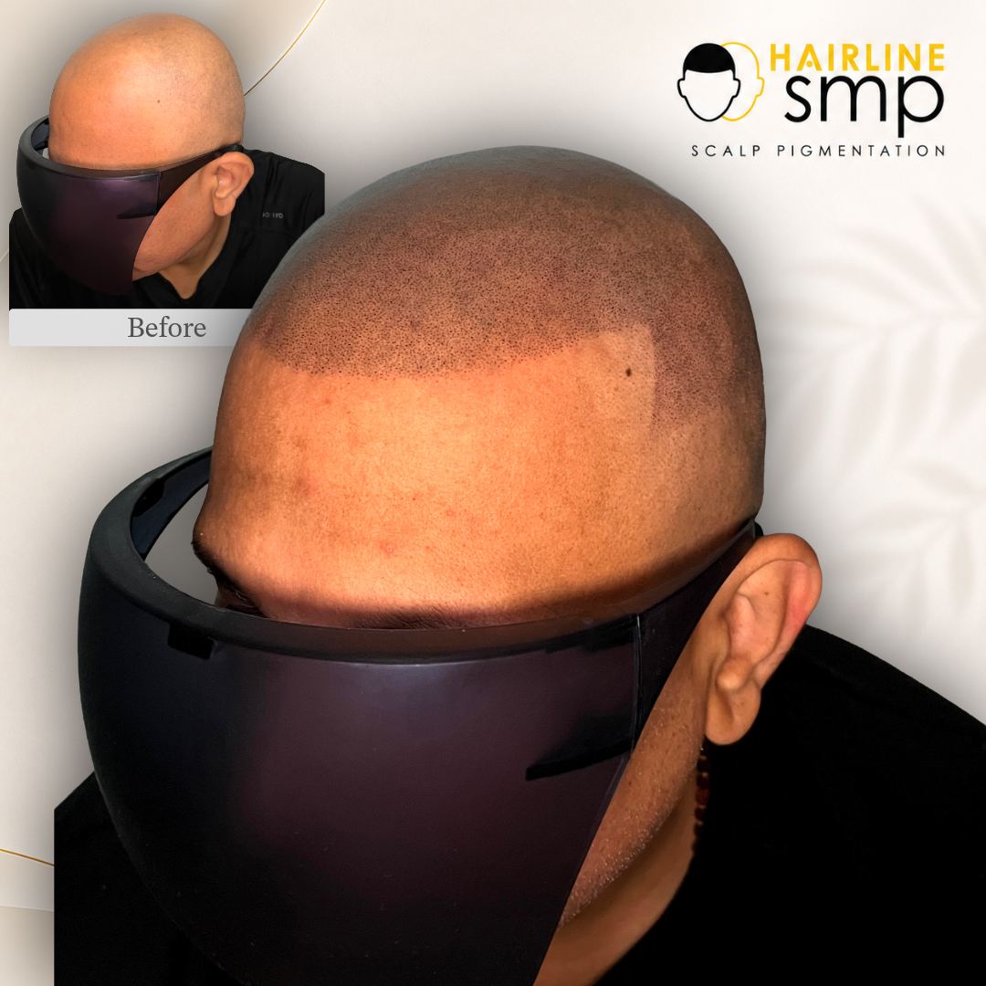 masterclass — scalp micropigmentation at Hairline SMP Zirakpur