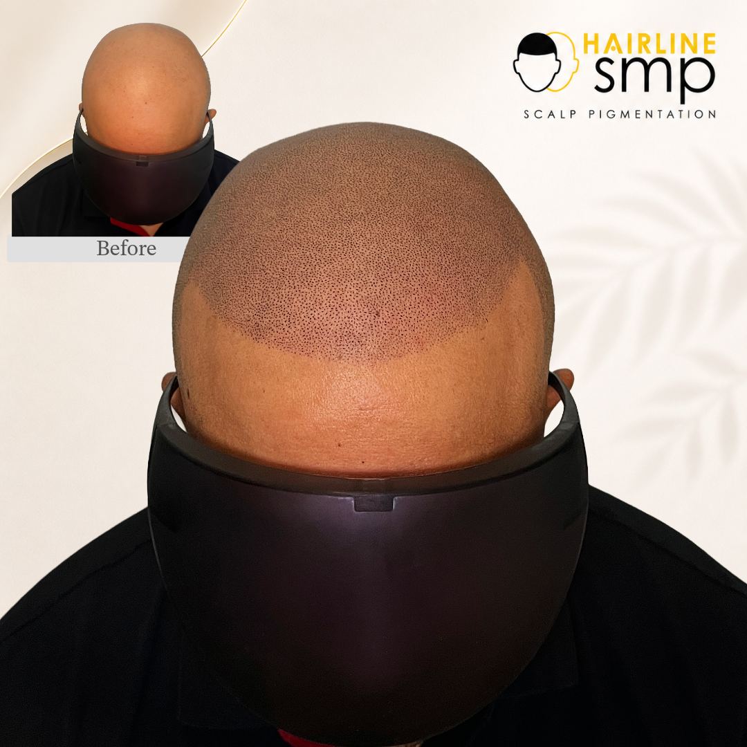 practitioner — scalp micropigmentation at Hairline SMP Zirakpur