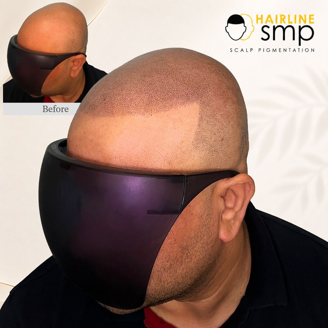 training — scalp micropigmentation at Hairline SMP Zirakpur