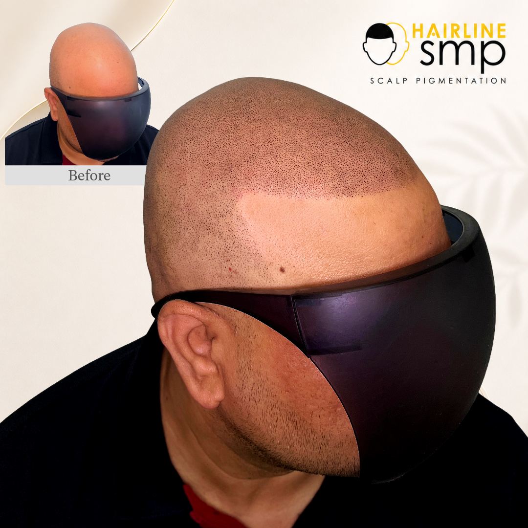 treatment — scalp micropigmentation at Hairline SMP Zirakpur